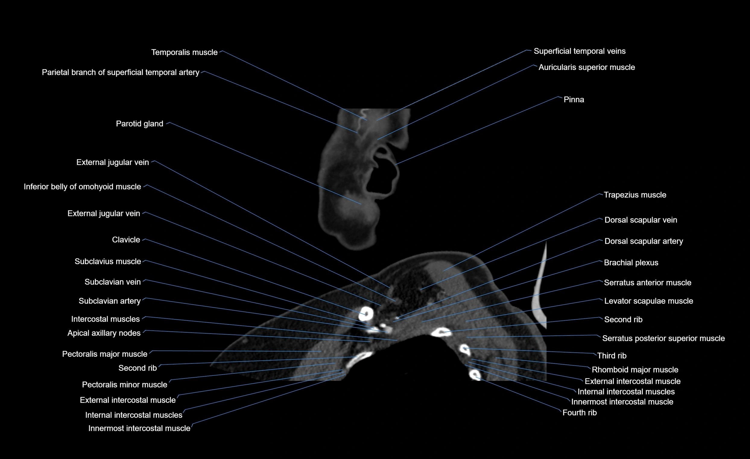 Neck CT sagittal cross sectional anatomy 3D  radiology  image-img-00001-00026.webp